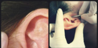 Auriculoterapia